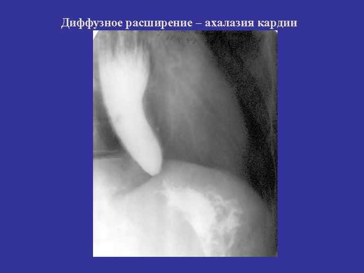 Диффузное расширение – ахалазия кардии 