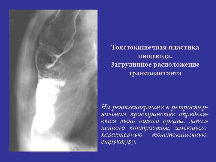 Толстокишечная пластика пищевода. Загрудинное расположение трансплантанта На рентгенограмме в ретростернальном пространстве определяется тень полого