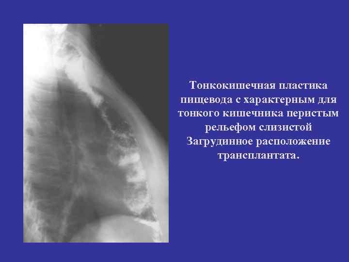 Тонкокишечная пластика пищевода с характерным для тонкого кишечника перистым рельефом слизистой Загрудинное расположение трансплантата.