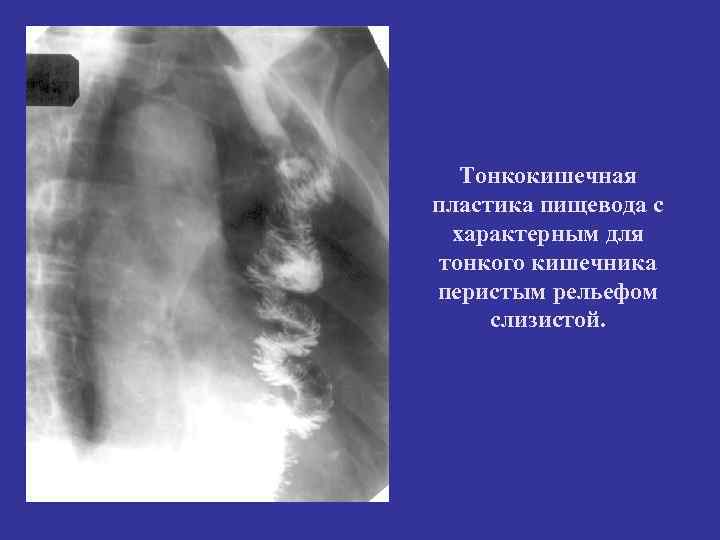 Тонкокишечная пластика пищевода с характерным для тонкого кишечника перистым рельефом слизистой. 
