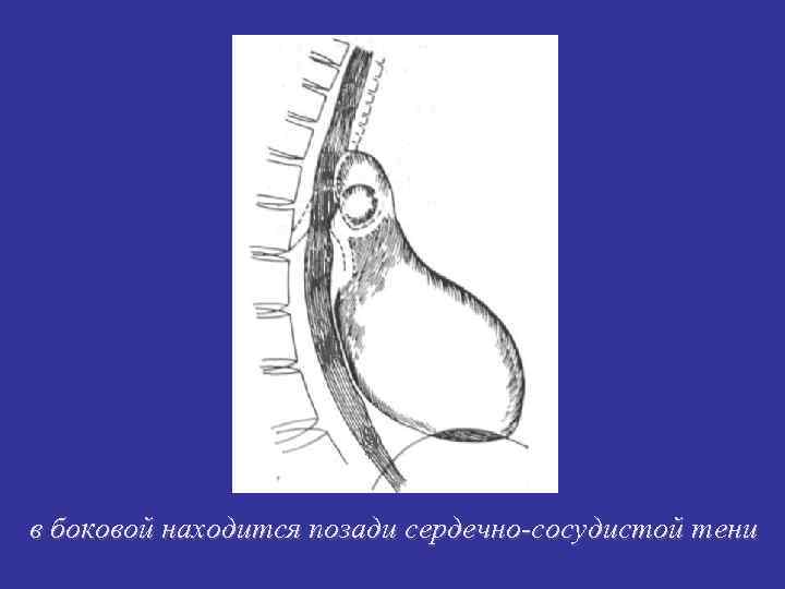 в боковой находится позади сердечно-сосудистой тени 