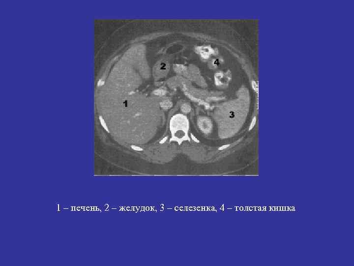 1 – печень, 2 – желудок, 3 – селезенка, 4 – толстая кишка 