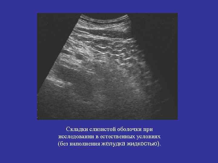Складки слизистой оболочки при исследовании в естественных условиях (без наполнения желудка жидкостью). 