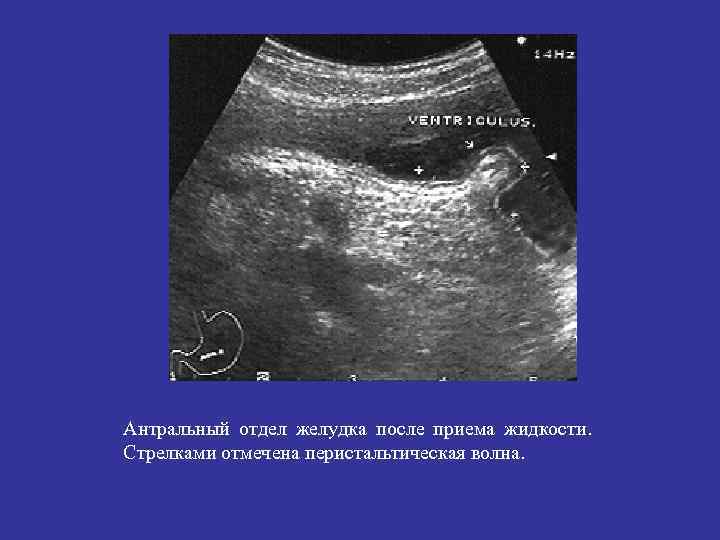 Антральный отдел желудка после приема жидкости. Стрелками отмечена перистальтическая волна. 