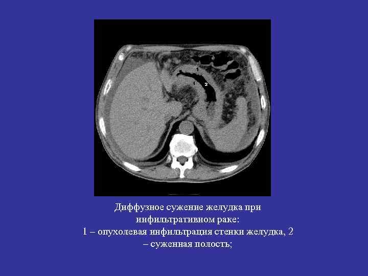 Диффузное сужение желудка при инфильтративном раке: 1 – опухолевая инфильтрация стенки желудка, 2 –