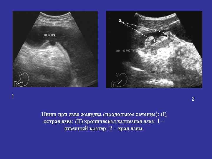 1 2 Ниши при язве желудка (продольное сечение): (I) острая язва; (II) хроническая каллезная