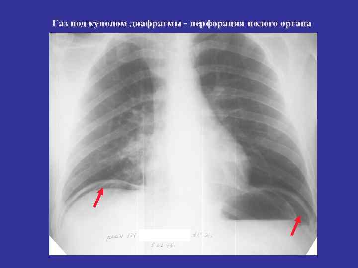 Газ под куполом диафрагмы - перфорация полого органа 