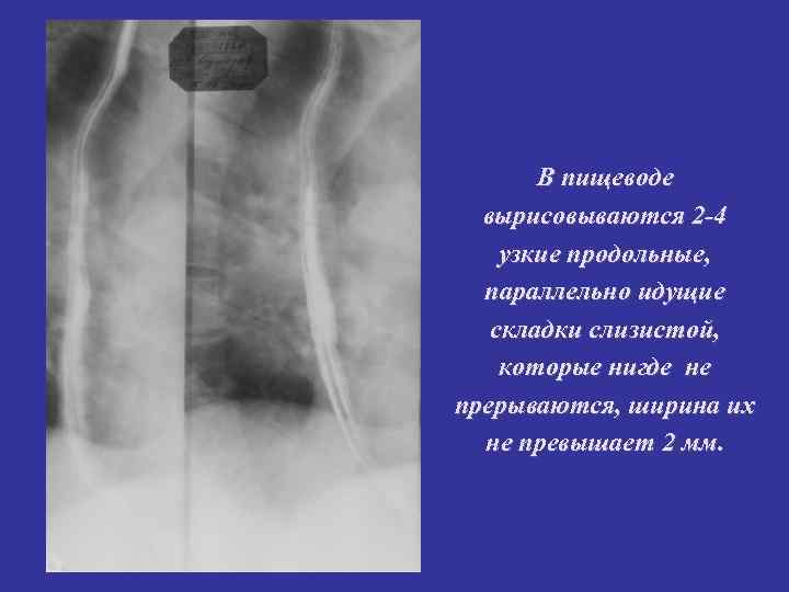 В пищеводе вырисовываются 2 -4 узкие продольные, параллельно идущие складки слизистой, которые нигде не