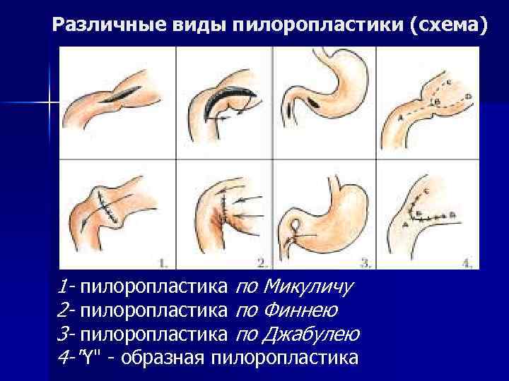 Пилоропластика по финнею схема