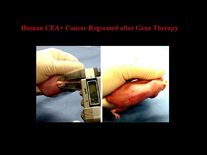 Human CEA+ Cancer Regressed after Gene Therapy 
