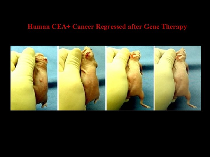 Human CEA+ Cancer Regressed after Gene Therapy 