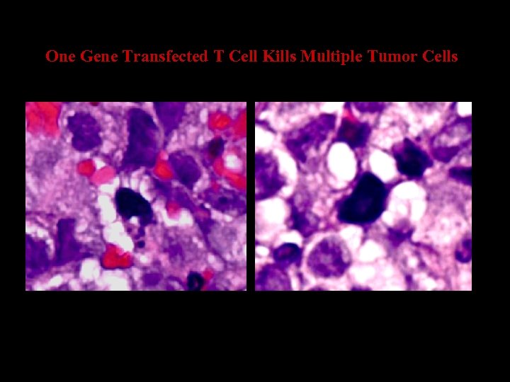 One Gene Transfected T Cell Kills Multiple Tumor Cells 