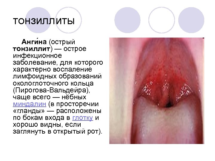 тонзиллиты Анги на (острый тонзиллит) — острое инфекционное заболевание, для которого характерно воспаление лимфоидных