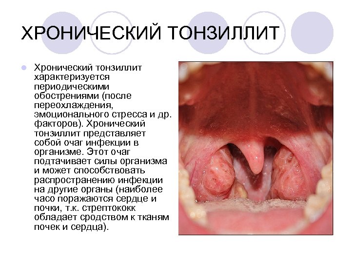 ХРОНИЧЕСКИЙ ТОНЗИЛЛИТ l Хронический тонзиллит характеризуется периодическими обострениями (после переохлаждения, эмоционального стресса и др.