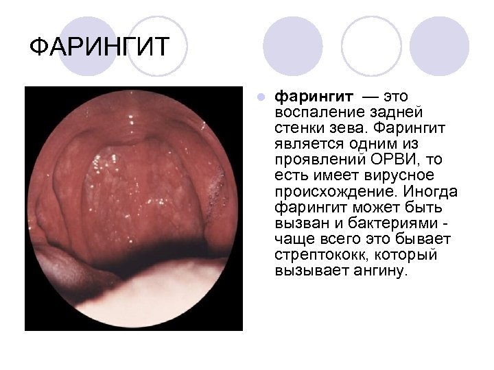 ФАРИНГИТ l фарингит — это воспаление задней стенки зева. Фарингит является одним из проявлений