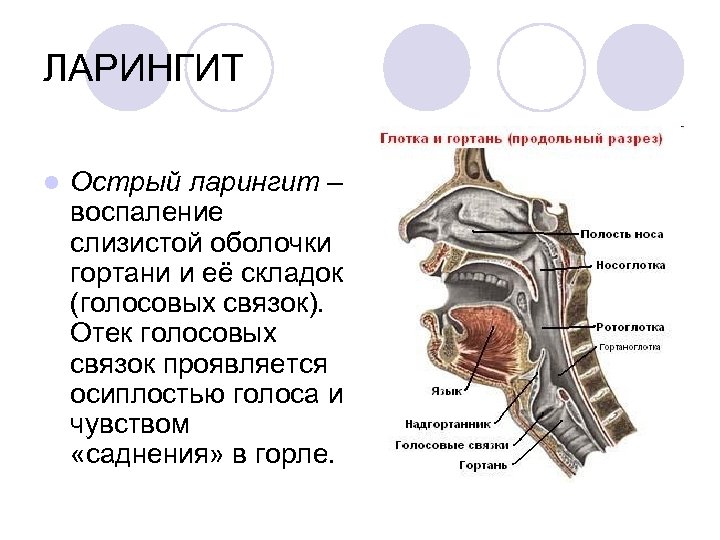 ЛАРИНГИТ l Острый ларингит – воспаление слизистой оболочки гортани и её складок (голосовых связок).