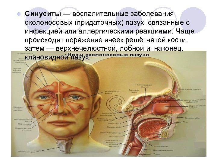 l Cинуситы — воспалительные заболевания околоносовых (придаточных) пазух, связанные с инфекцией или аллергическими реакциями.