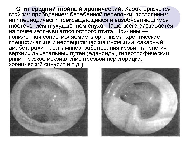 Отит средний гнойный хронический. Характеризуется стойким прободением барабанной перепонки, постоянным или периодически прекращающимся и