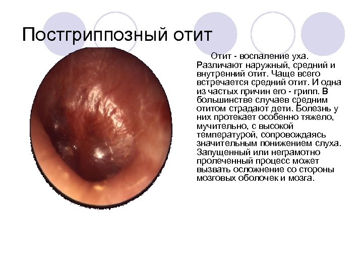 Постгриппозный отит Отит воспаление уха. Различают наружный, средний и внутренний отит. Чаще всего встречается