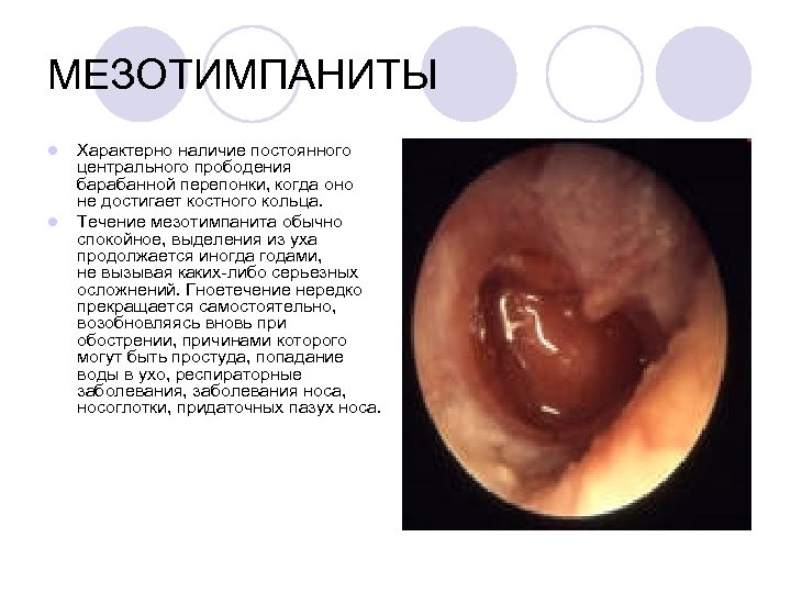 МЕЗОТИМПАНИТЫ l l Характерно наличие постоянного центрального прободения барабанной перепонки, когда оно не достигает