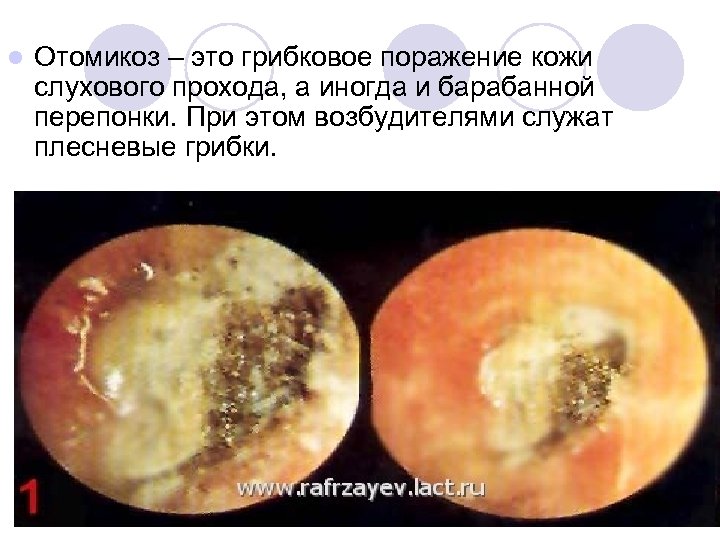 l Отомикоз – это грибковое поражение кожи слухового прохода, а иногда и барабанной перепонки.