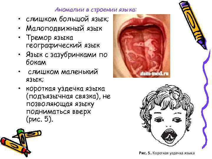 Аномалии в строении языка: • слишком большой язык; • Малоподвижный язык • Тремор языка