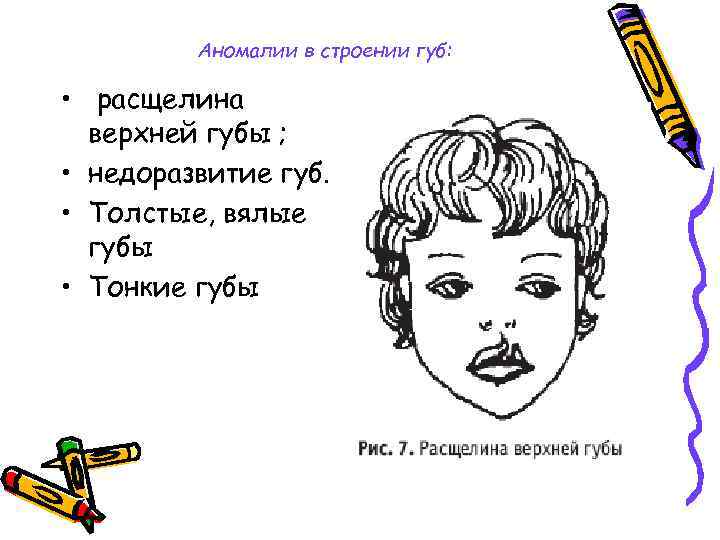 Аномалии в строении губ: • расщелина верхней губы ; • недоразвитие губ. • Толстые,