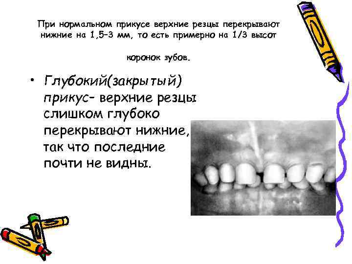При нормальном прикусе верхние резцы перекрывают нижние на 1, 5– 3 мм, то есть