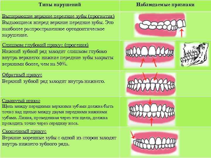 Типы нарушений Выпирающие верхние передние зубы (прогнатия) Выдающиеся вперед верхние передние зубы. Это наиболее