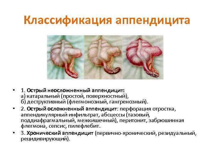 Классификация аппендицита • 1. Острый неосложненный аппендицит: а) катаральный (простой, поверхностный), б) деструктивный (флегмонозный,