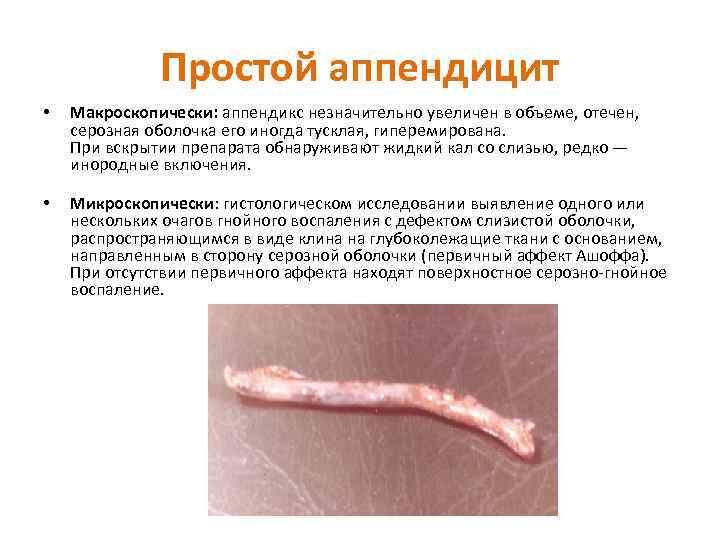 Простой аппендицит • Макроскопически: аппендикс незначительно увеличен в объеме, отечен, серозная оболочка его иногда