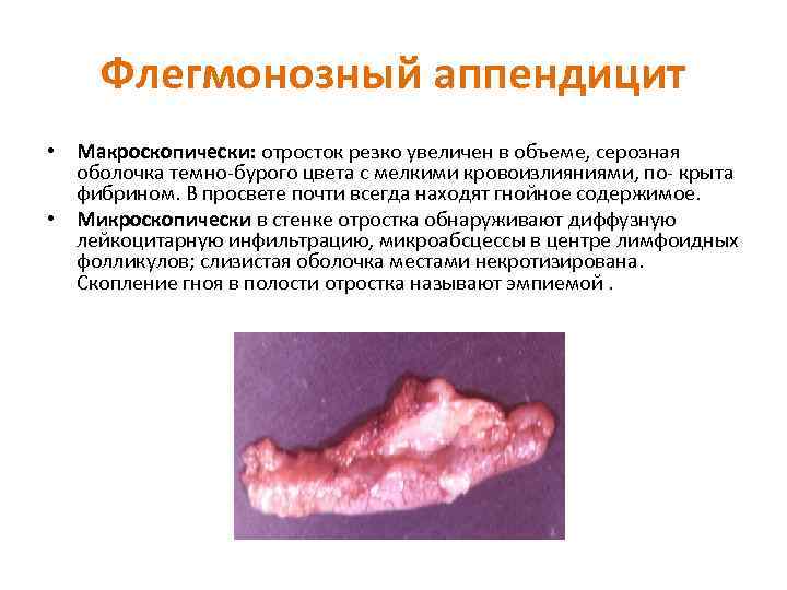 Флегмонозный аппендицит • Макроскопически: отросток резко увеличен в объеме, серозная оболочка темно бурого цвета