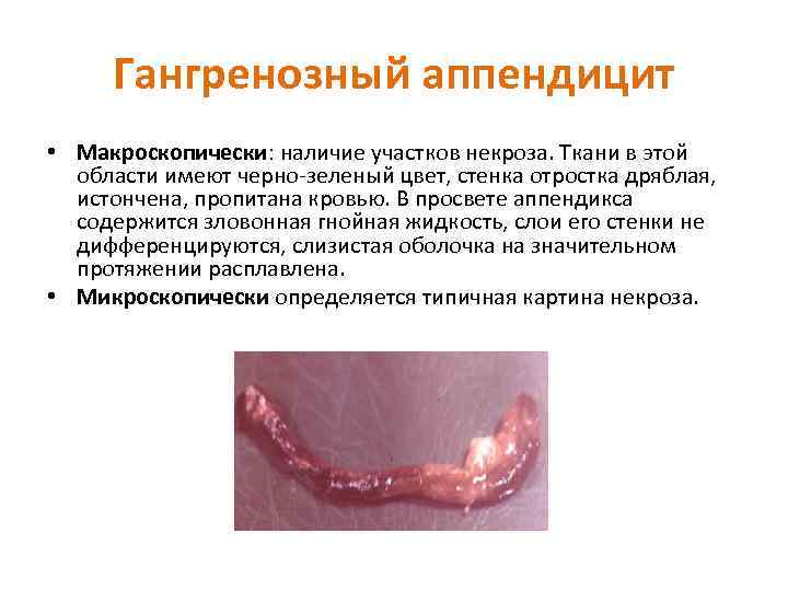 Гангренозный аппендицит • Макроскопически: наличие участков некроза. Ткани в этой области имеют черно зеленый