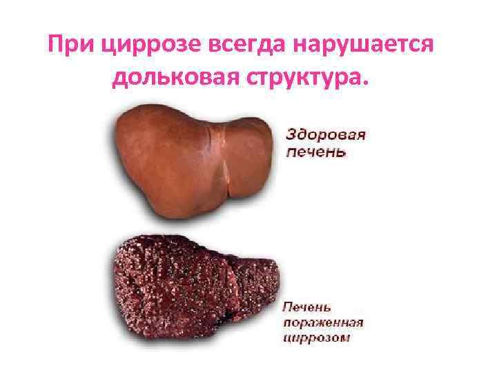 При циррозе всегда нарушается дольковая структура. 