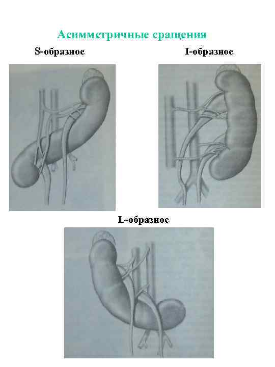 Асимметричные сращения S-образное I-образное L-образное 