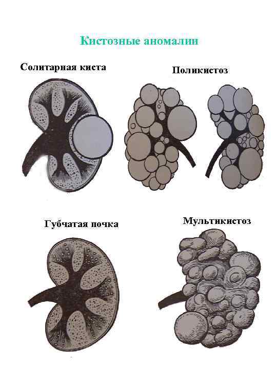 Кистозные аномалии Солитарная киста Губчатая почка Поликистоз Мультикистоз 