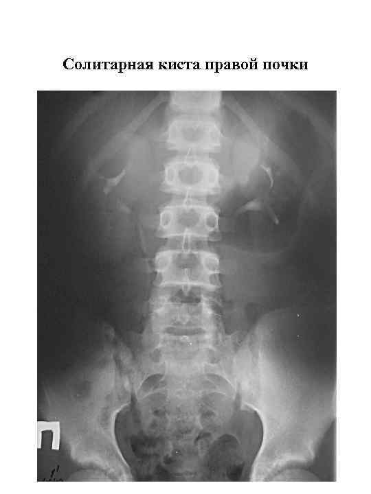 Солитарная киста правой почки 