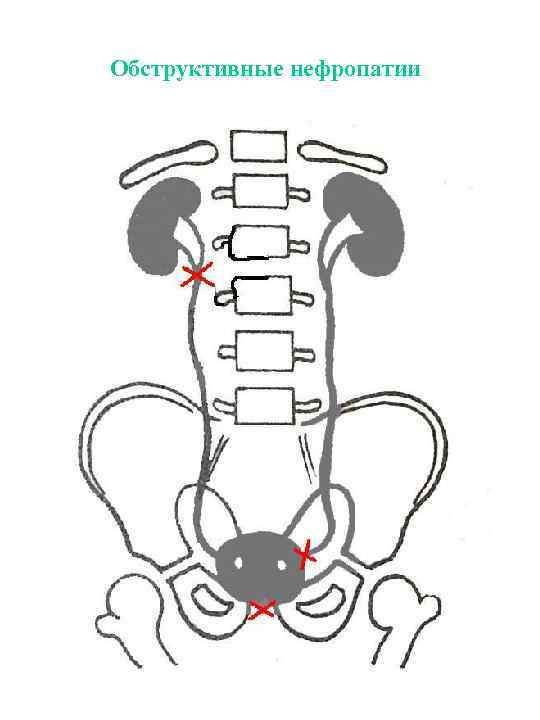 Обструктивные нефропатии 