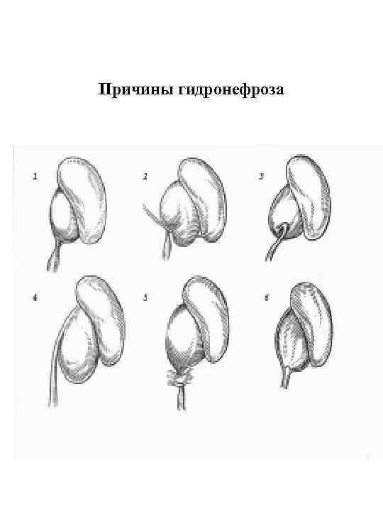 Причины гидронефроза 