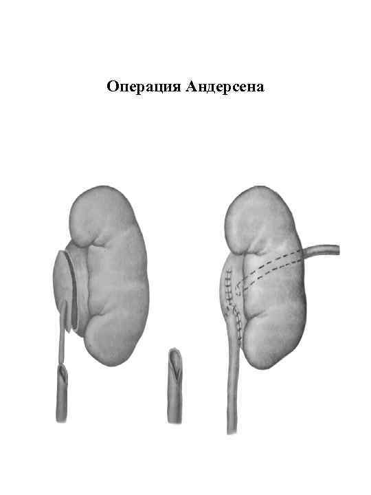 Операция Андерсена 