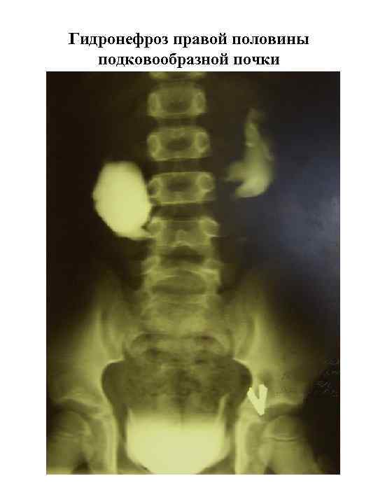 Гидронефроз правой половины подковообразной почки 