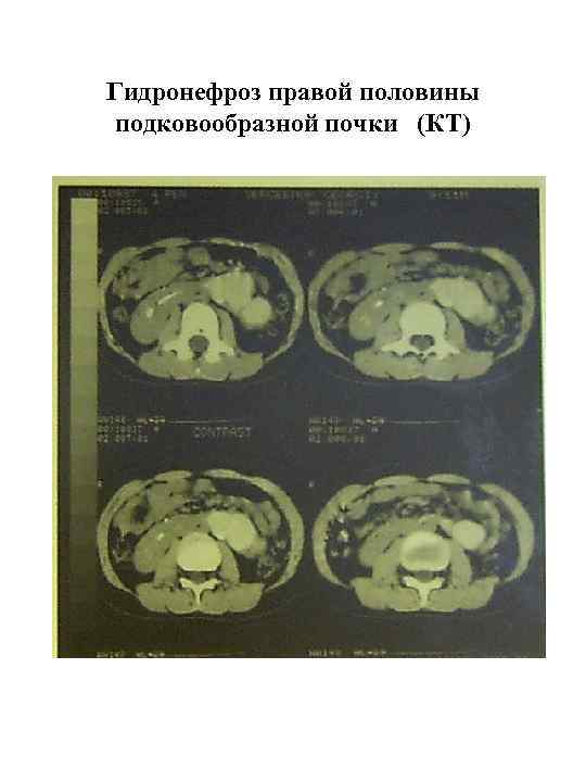 Гидронефроз правой половины подковообразной почки (КТ) 