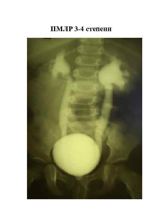 ПМЛР 3 -4 степени 
