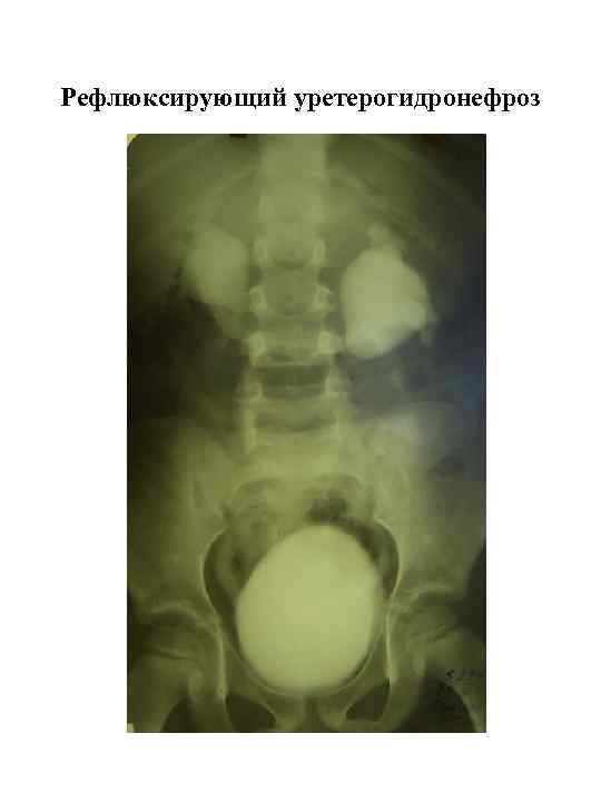 Рефлюксирующий уретерогидронефроз 