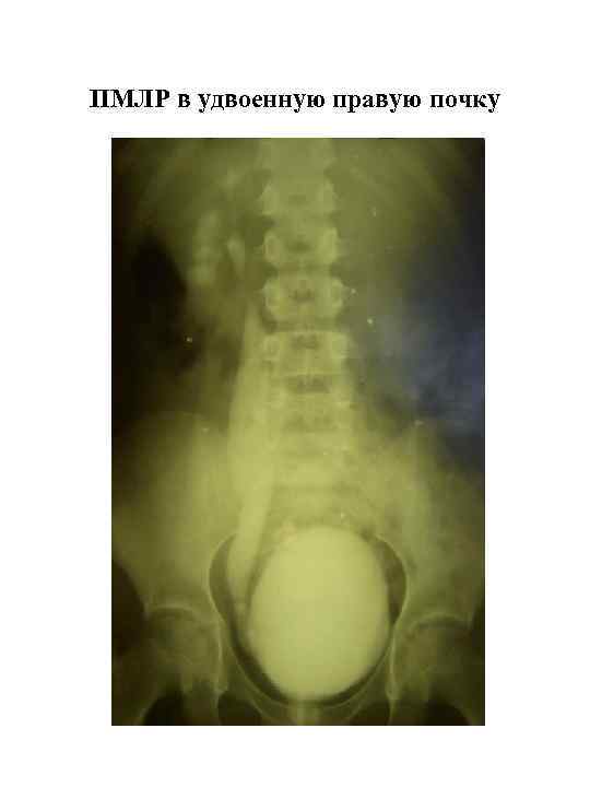 ПМЛР в удвоенную правую почку 