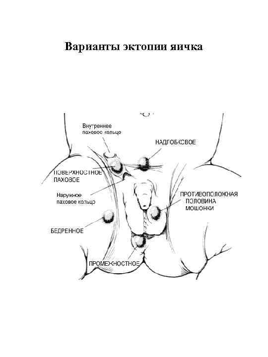 Варианты эктопии яичка 