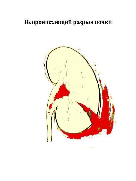 Непроникающий разрыв почки 