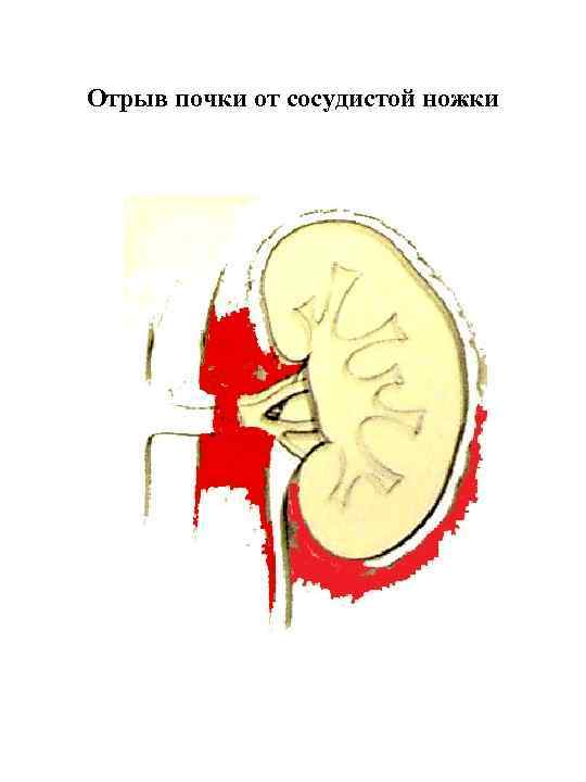 Отрыв почки от сосудистой ножки 