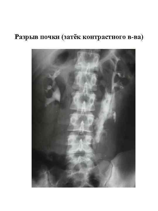 Разрыв почки (затёк контрастного в-ва) 