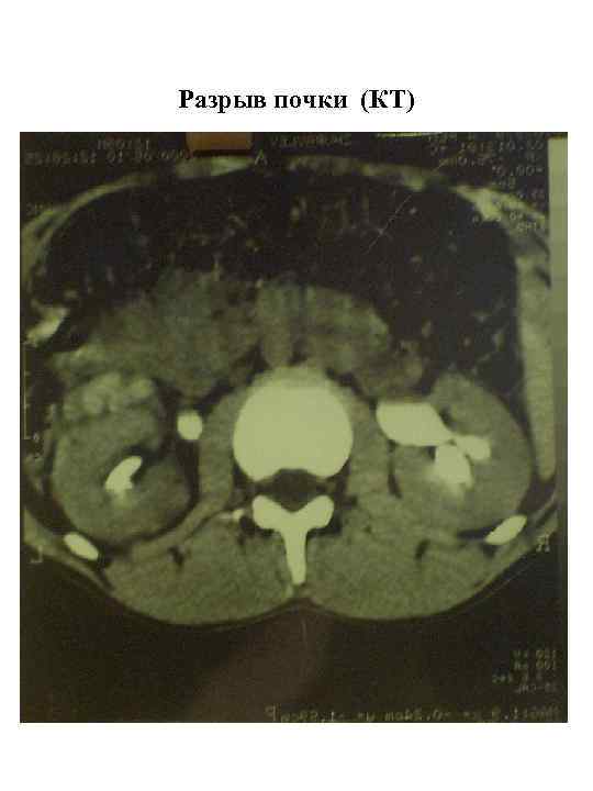 Разрыв почки (КТ) 